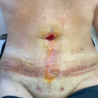Addome nei primi giorni dopo l'intervento: ecchimosi, cerotti e segni della medicazione attorno alle incisioni