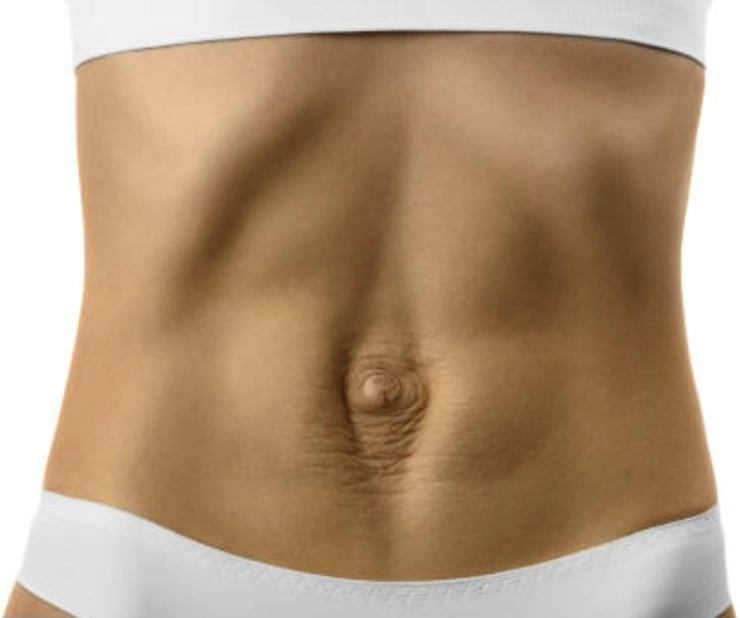 Linea alba, linea arcuata e linea semilunare: anatomia della parete addominale — cos e diastasi e sintomi