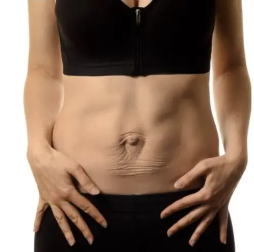 Linea alba, linea arcuata e linea semilunare: anatomia della parete addominale — cose la diastasi preview
