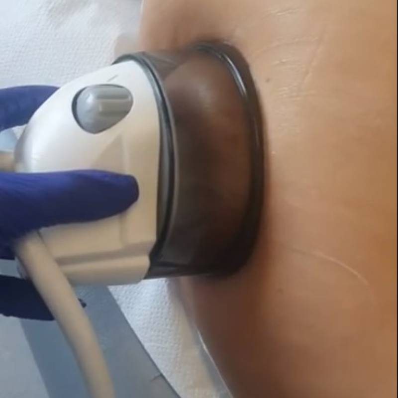 Primo piano della ventosa che solleva una plica di pelle durante il massaggio endodermico