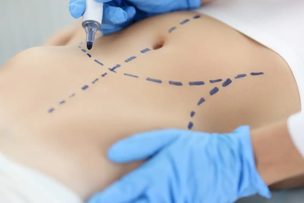 Che cos'è la lipoaspirazione