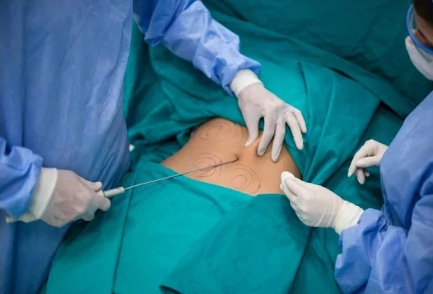 Definizione della lipoaspirazione