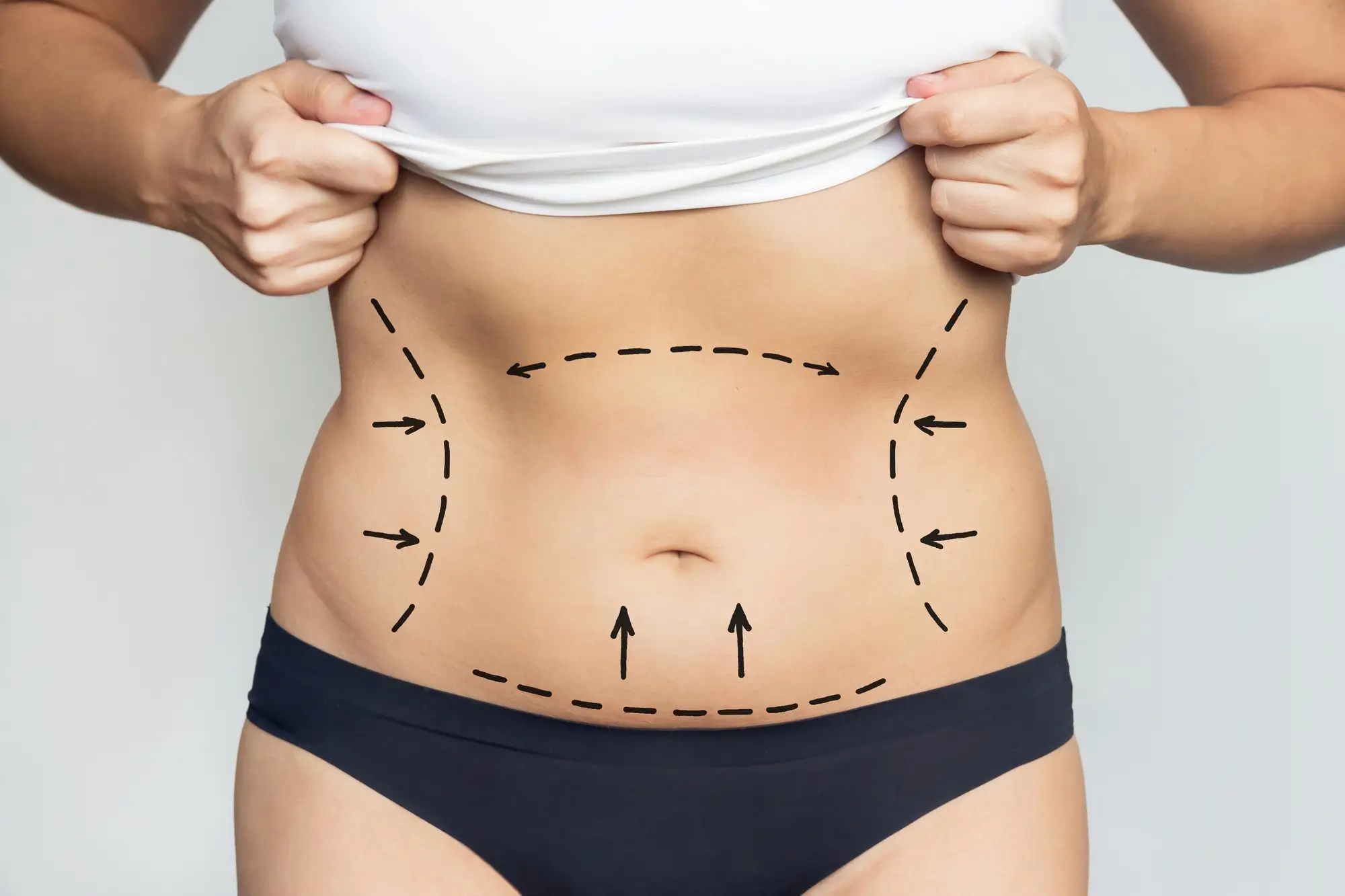 Lipoaspirazione e strumenti ancillari