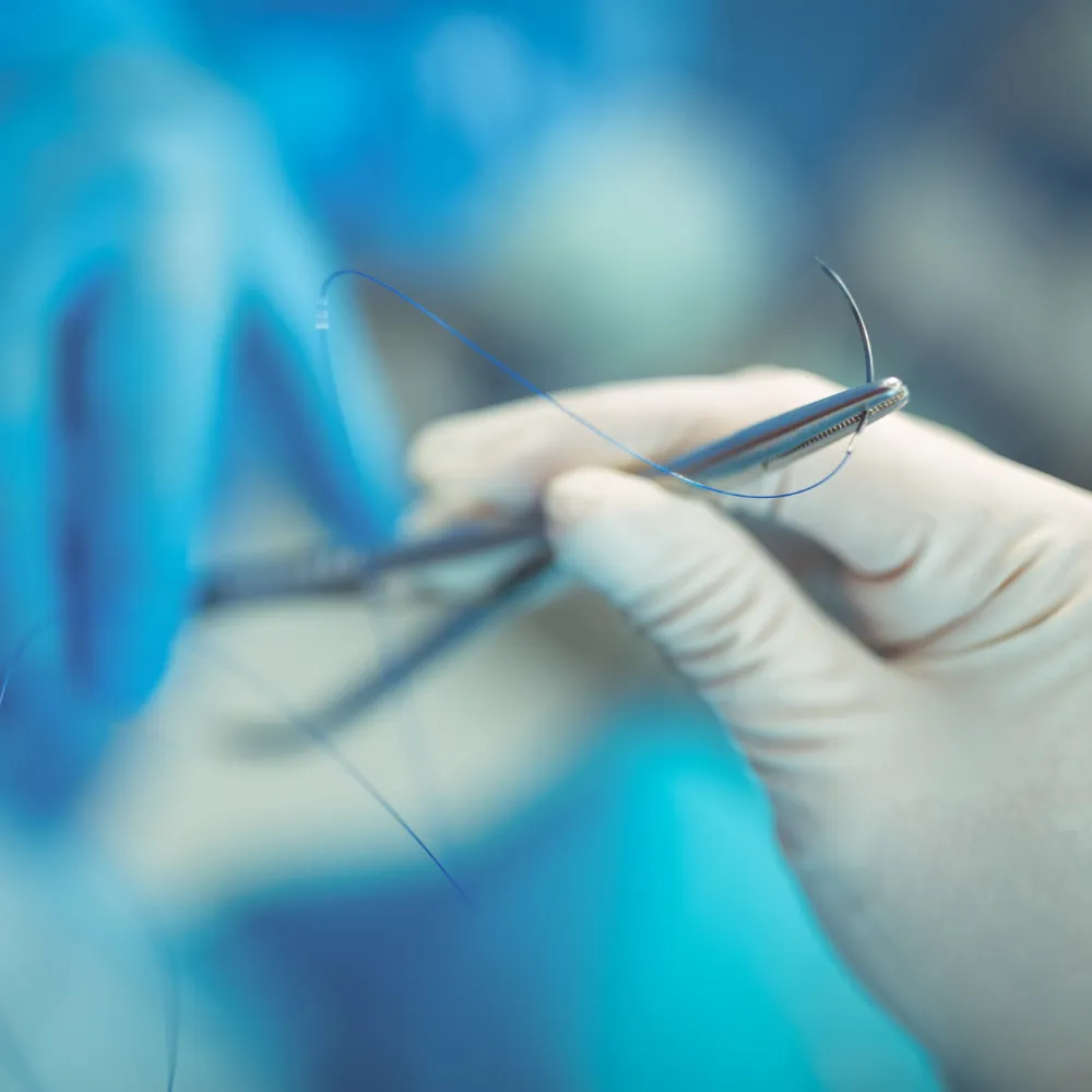 Diastasi addominale: quando operarsi e quando no — tecniche chirurgiche