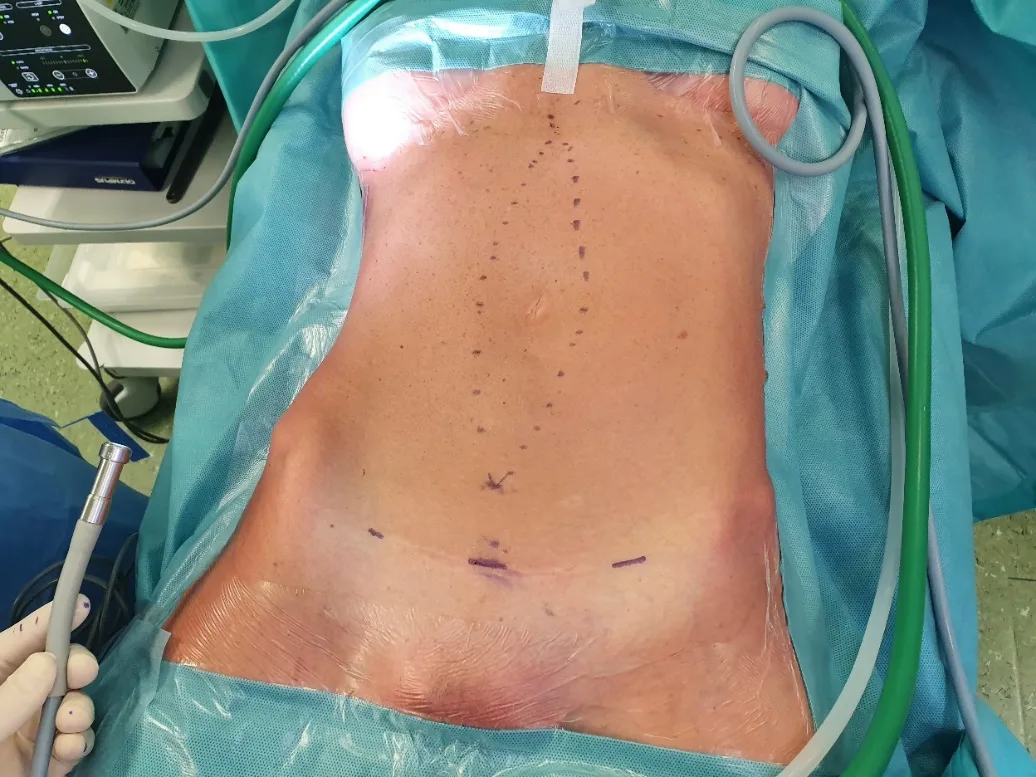 TESAR, fase 1: marcatura pre-operatoria della linea mediana e dei margini della diastasi