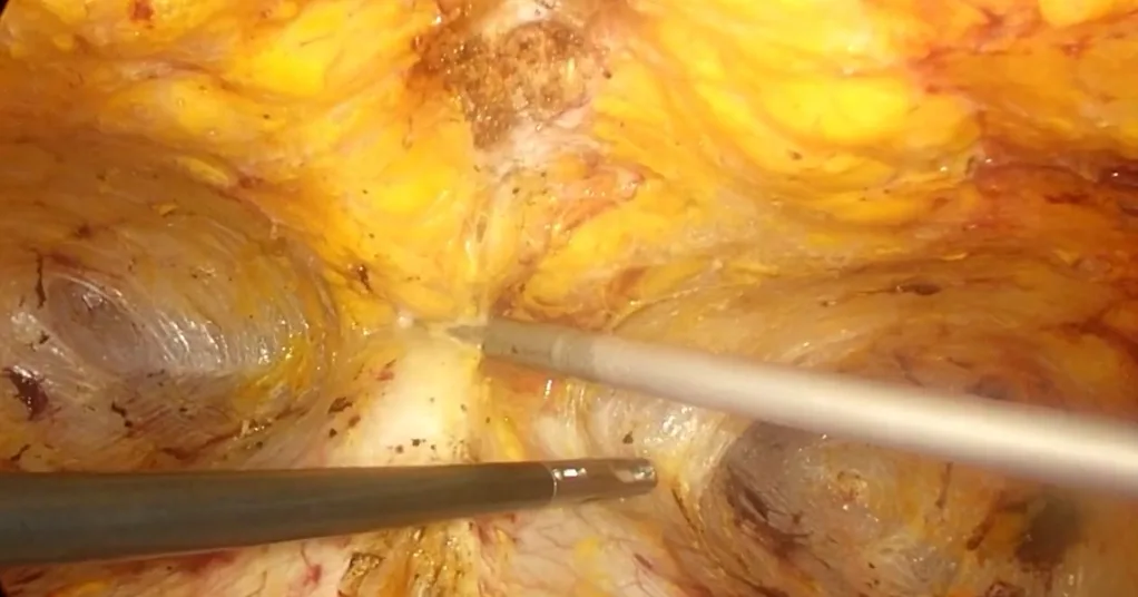 TESAR, fase 3: dissezione endoscopica dello spazio prefasciale con strumento a energia
